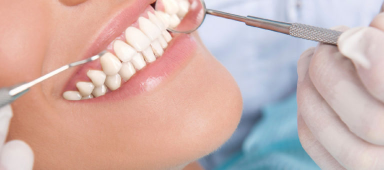 Las Carillas Dentales: nueva estética para una mejor sonrisa
